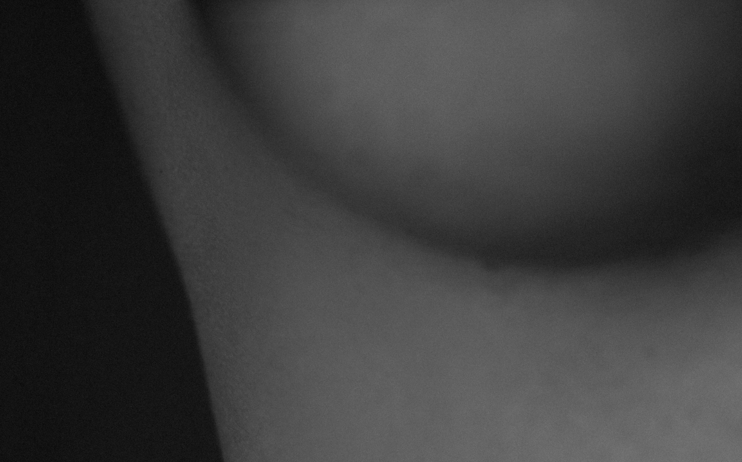 Zweiteingriffe der Brust nach Vor-Operation, Ersatz von Prothesen in Hamburg