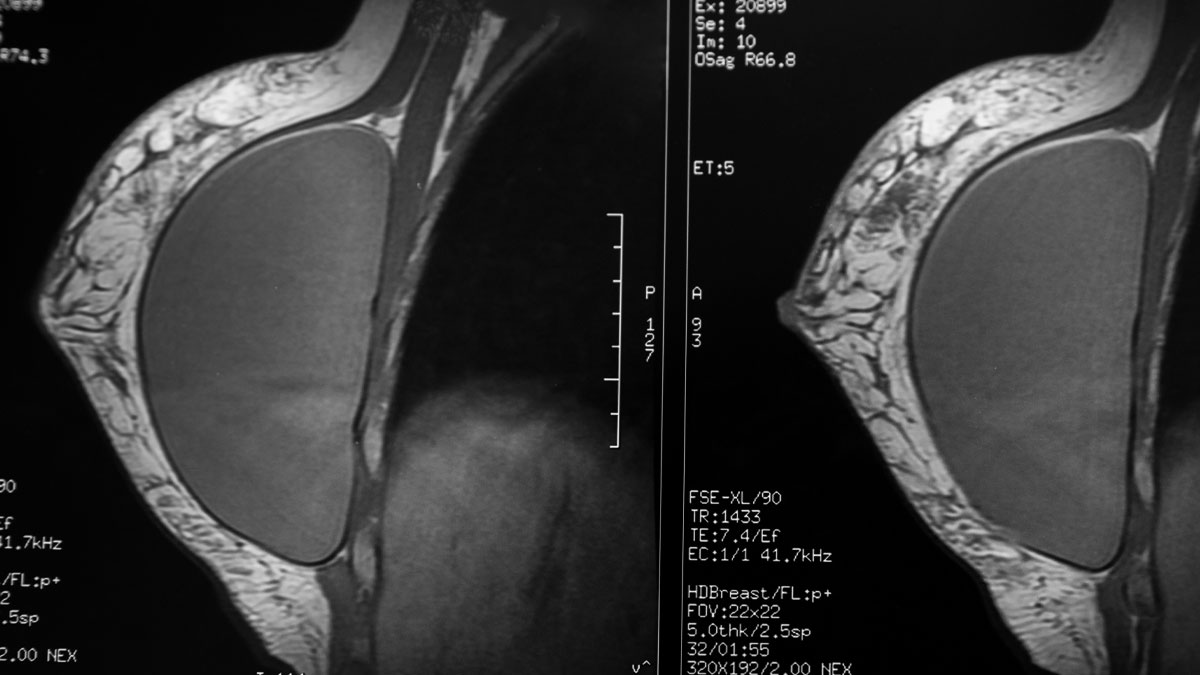 Kapselfibrose Vorbeugen Mit Ultraschall FBQA Kapselfibrose Vorbeugen Mit Ultraschall FBQA